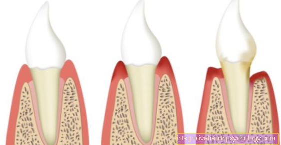 Chronic periodontal disease