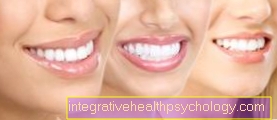 Duration of the whitening and the whitening result
