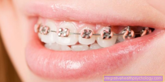 The fixed braces