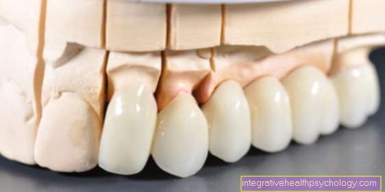 The durability of dental implants