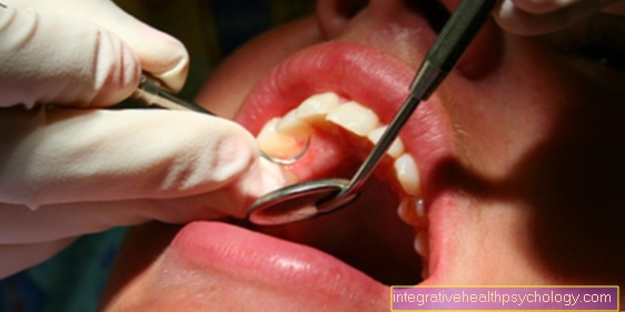 Parodontálne ochorenie