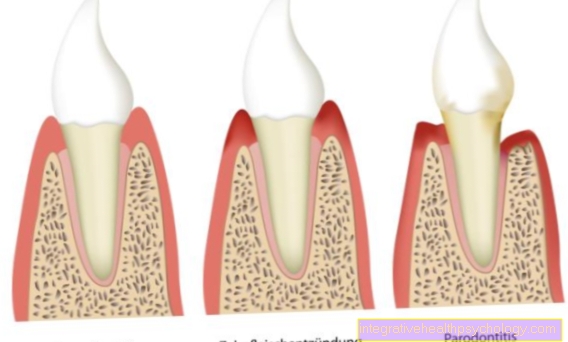 Periodontální onemocnění a periodontální onemocnění