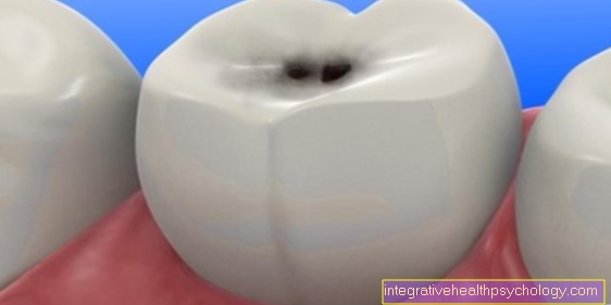 Hampaiden rappeutumisen oireet