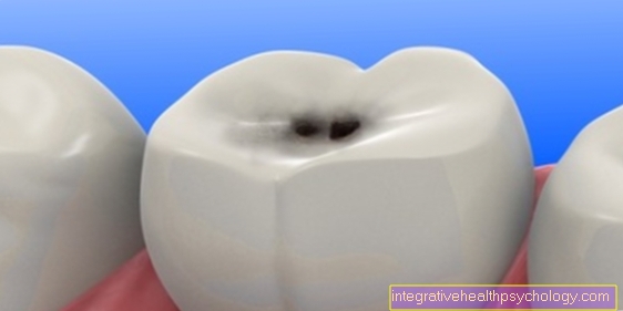 Как се развива кариес на зъбите?