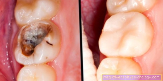 Kā var atpazīt zobu samazinājumu?