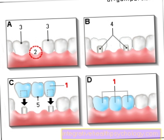 Zubní můstek jako zubní protéza